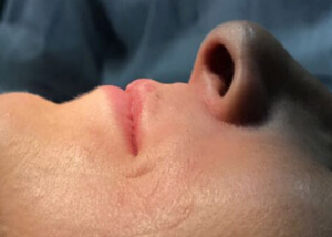 patient profile after bone block treatment