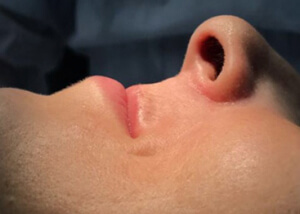 patient profile before bone block treatment