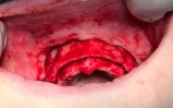 detail of patient's mouth before bone block treatment