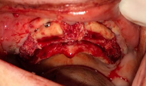 detail of patient's mouth during bone block treatment