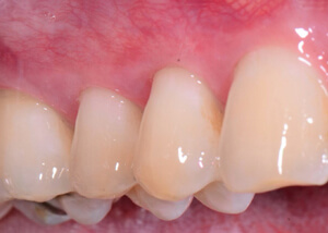 teeth and gums after connective tissue graft treatment