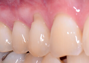 teeth and gums before connective tissue graft treatment