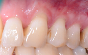 another view of teeth and gums before connective tissue graft treatment