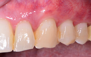 another view of teeth and gums after connective tissue graft treatment