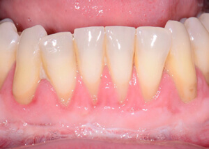 teeth and gums after free gingival graft treatment