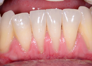 teeth and gums before free gingival graft treatment