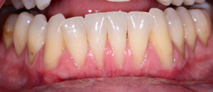 pre-op image of teeth and gums receiving free gingival graft treatment