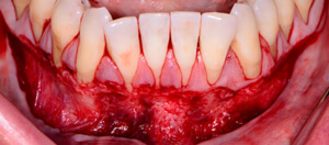 preparation image of teeth and gums receiving free gingival graft treatment