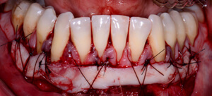 sling suturing image of teeth and gums receiving free gingival graft treatment