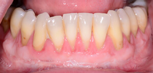 post-op image of teeth and gums receiving free gingival graft treatment
