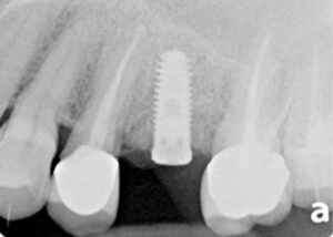 x-ray image of teeth after peri-implantitis treatment