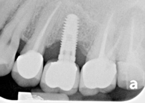 x-ray image of teeth before peri-implantitis treatment