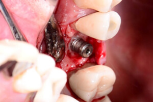 image of implant fixture before peri-implantitis treatment