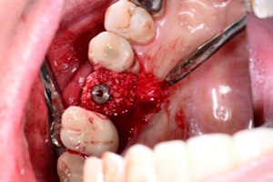 image of implant fixture after peri-implantitis treatment